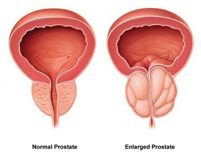 what causes enlarged prostate