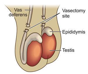 What is Vasectomy Recovery Like?