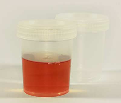 Blood In Urine Color
